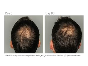 ViviscalMan Before & After Hair Supplementt