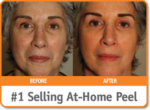 alpha beta face peel