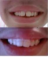 2 Orthodontic+Gap+Teeth+Bands+Heavy