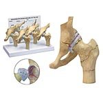 4-stage Arthritic Hip Model Set