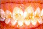D.I.Y)10 Thermo-molding "BOIL and BITE" Mouth Trays by Instant White Smile Wholesale
