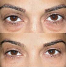 eyeliss serum
