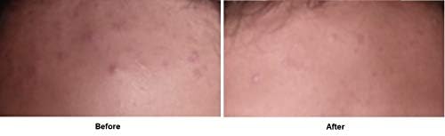 dennis gross spotlite