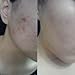 [BONAJOUR] Extreme Acne Blemish Spot Repair & Remove Serum - The Best Acne Blemish Clear Repair & Brightening & Remove Acne Serum 1.7Fl.oz