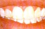 D.I.Y)10 Thermo-molding "BOIL and BITE" Mouth Trays by Instant White Smile Wholesale