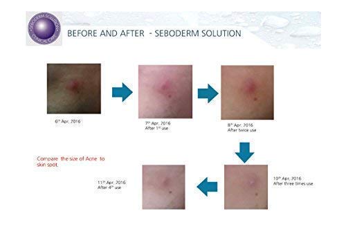 Acne Treatment Seboderm Solution Anti Acne Sebum Blemish Prone Skin Pore Care. (Serum)