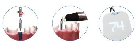 IDS Mega ISQ SmartPeg Type 32 (Zimmer) Pkg/5