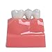 Annhua 4 Times Dental Implant Teeth Model Analysis Crown Bridge Demonstration Model, Dental Teeth Crown Roots Removable for Education, Patients Communication, Learning and Lab