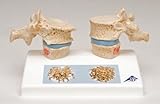 Osteoporosis Model