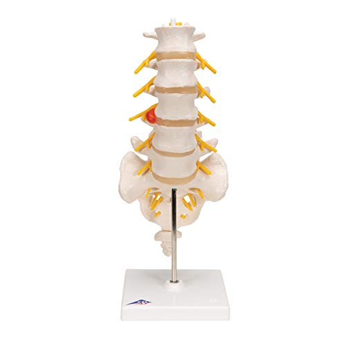 3B Scientific A76/5 Lumbar Spinal Column with Dorso-Lateral Prolapsed Intervertebral Disc, 13.4
