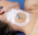 Tegaderm CHG Chlorhxidine Gluconate Iv Securement Dressing 4