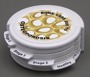 Osteoporosis Anatomical Disk Set Classroom Education Model CEM