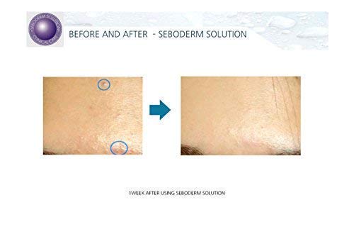 Acne Treatment Seboderm Solution Anti Acne Sebum Blemish Prone Skin Pore Care. (Serum)