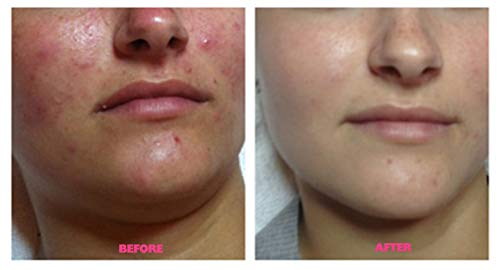 30% Salicylic Acid Skin Peel with Tea Tree Oil & Green Tea Extract - Great For Acne Free Shipping and Free Fan Brush
