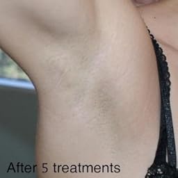 Amazon Com Customer Reviews Laser Hair Removal For Women Men