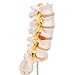 3B Scientific A76/5 Lumbar Spinal Column with Dorso-Lateral Prolapsed Intervertebral Disc, 13.4
