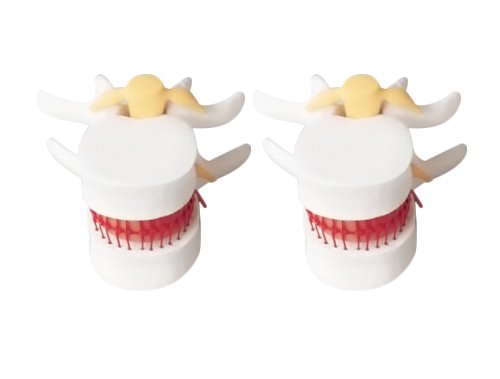 Zgood Dental 1:1.5 Medical Spine Lumbar Disc Herniation Model