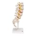 3B Scientific A76/5 Lumbar Spinal Column with Dorso-Lateral Prolapsed Intervertebral Disc, 13.4