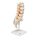 3B Scientific A76/5 Lumbar Spinal Column with Dorso-Lateral Prolapsed Intervertebral Disc, 13.4
