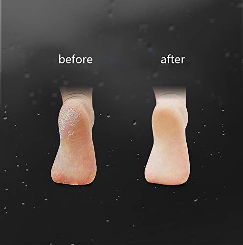 ZIZZON Foot Care Callus Corn Shaver Hard Skin Remover Color Wood Handle 10 Blades (Gourd shaped handle)
