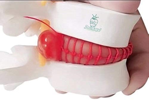 Revitive Medic 2024 New Human Anatomical Lumbar Herniation Model, Vertebrae Degenerative Lumbar Human Spine Model 1pcs Lumbar Spine Model For Teaching Learning Skins Compression