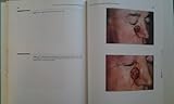 Atlas of Cutaneous Facial Flaps and Grafts : A Differential Diagnosis of Wound Closures, Moy, Ronald L., 0812113136