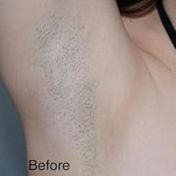 Amazon Com Customer Reviews Laser Hair Removal For Women Men