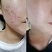 [BONAJOUR] Extreme Acne Blemish Spot Repair & Remove Serum - The Best Acne Blemish Clear Repair & Brightening & Remove Acne Serum 1.7Fl.oz