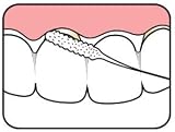 TePe Bridge & Implant Floss Brand TePe Dental Care Kit view 4