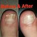 Antifungal Natural Treatment System Solution Kit (3 Piece) - Treats Toenail Fungus, Nail Fungus, and Discolored Nails.