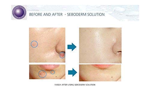 Acne Treatment Seboderm Solution Anti Acne Sebum Blemish Prone Skin Pore Care. (Serum)