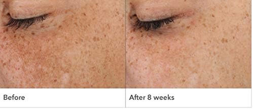 dr dennis gross dark spot serum