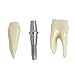 Annhua 4 Times Dental Implant Teeth Model Analysis Crown Bridge Demonstration Model, Dental Teeth Crown Roots Removable for Education, Patients Communication, Learning and Lab