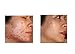 Natural Acne Treatment & Scar Cream | Benzoyl Peroxide Free Fast Zit Remedy for Cystic, Hormonal, Teen, Adult & Body Acne Pimples. Safe Organic Solution for Blemish Free Skin