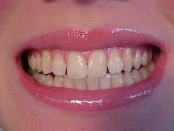 D.I.Y)10 Thermo-molding "BOIL and BITE" Mouth Trays by Instant White Smile Wholesale