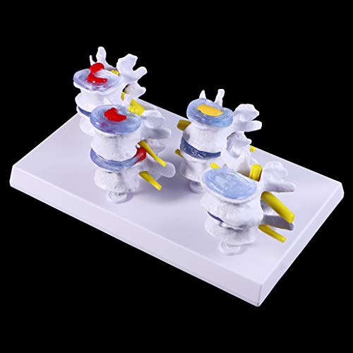 Abicial 1 Set Human Lumbar Lesion Spine Statue Display Model Medical Teaching Learning Tool
