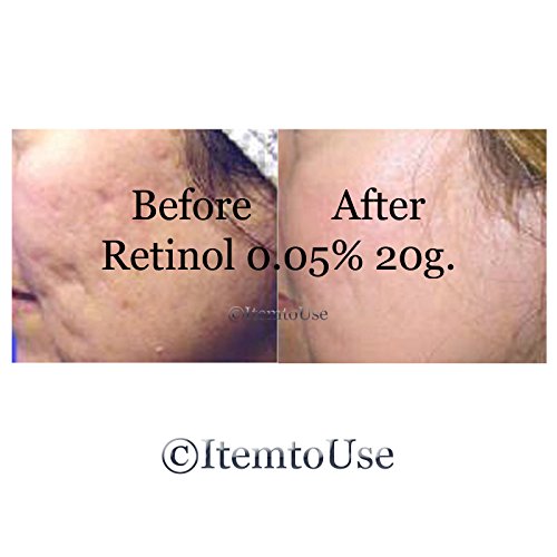 retin a cream for acne price retin a cream for acne price