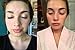 Natural Acne Cleanser - Gentle Face Wash To Clear and Control Acne Prone Skin - Tea Tree Oil, Aloe Vera & Gentle Essential Oils For A Refreshing Deep Clean - For Teens and Adults by Keeva Organics