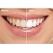 Dentive Teeth Whitening Tray Light Professional 16 LEDs Teeth Whitener Kit with 3 Adapters Cable, Works with Teeth Whitening Strips, Toothpaste or Gel