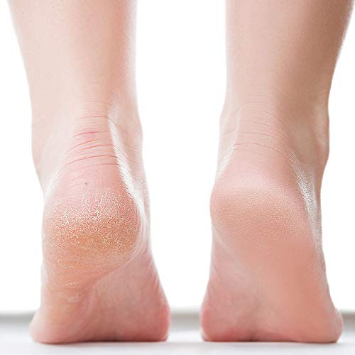 ForPro Premium Callus No More is a fast-acting, quick-drying callus removing formula that is designed to eliminate stubborn, tough calluses from your feet. It is specially formulated with powerful ingredients that work together to break down the hard, thickened skin and remove even the most stubborn calluses.

The formula contains high-quality ingredients like Salicylic Acid, Urea, and Lactic Acid that are known for their exfoliating and moisturizing properties. These ingredients work to gently exfoliate and soften the dry, rough skin on your feet, making it easier to remove the calluses.

In addition to its powerful ingredients, ForPro Premium Callus No More is also quick-drying, so you don't have to worry about any mess or residue. The formula is easy to use and comes in a convenient spray bottle that makes it easy to apply.

Overall, ForPro Premium Callus No More is an effective solution for those struggling with tough calluses on their feet. It uses powerful ingredients to soften and exfoliate the skin, making it easier to remove the calluses and leaving your feet looking and feeling smooth and soft. Description by ChatGPT.