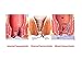 Hemorrhoids Cream-Chinese Herbal for Treatment Hemorrhoids Cream Anus Prolapse Anal Fissure Antibacterial Cream (4)