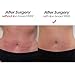 Fajate Virtual Sensuality Fajate Post Surgery Abdominal Compression LIPO Board Flat ABS 9002 Tabla Abdominal