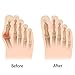 comenzar Bunion Corrector ，Treat Pain in Hallux Valgus, Big Toe Joint, Hammer Toe, Toe Separators Spacers Straighteners Splint Aid Surgery Treatment Men/Women（ Bunion Relief Protector Sleeves Kit）