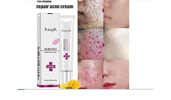 acne scar removal cream amazon