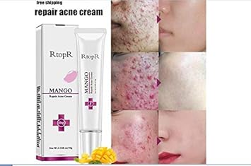 acne removal ointment
