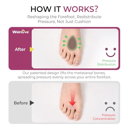 Welnove Unisex Metatarsal Pad-Leather Forefoot Pad Provides Metatarsal Support-Soft Insoles for Metatarsalgia and Morton's Neuroma-Shoe Friendly(S)
