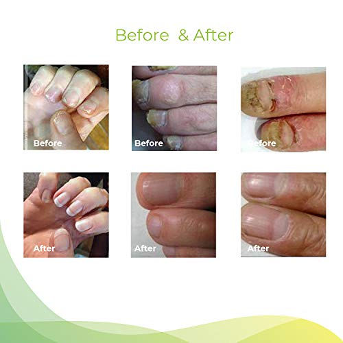 2 Samsali+Toenail+Treatment+Effective+Fingernail