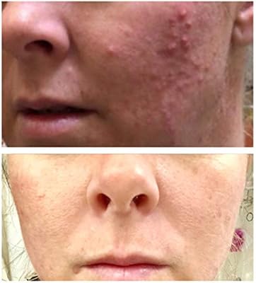 Amazon Com Glycolic Acid 70 Professional Chemical Peel Intense Alpha Hydroxy Acid Skin Peel For Acne Scarring Wrinkles Fine Lines And Brown Spots 1 Fl Oz Beauty