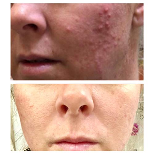 Glycolic Acid 40% Chemical Peel - Intense Alpha Hydroxy Acid Skin Peel For Acne Scarring, Wrinkles,  - //medicalbooks.filipinodoctors.org