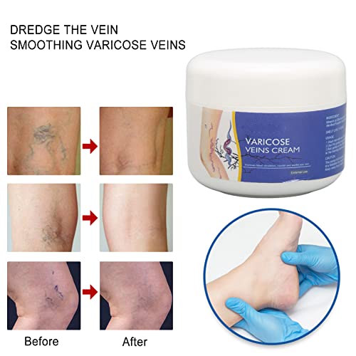 Veins Treatment For Legs Varicose Veins Treatment Cream For Legs - Natural Pain Relief & Circulation, 2 Fl Oz Varicose Veins Circulation - Foto 4